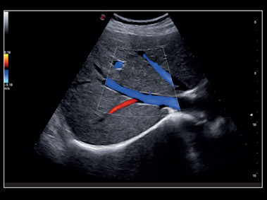 Clinical Image - MyLab<sup>™</sup>X8 Platform - Liver - CPI with color Doppler