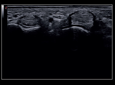 Clinical Image - MyLab<sup>™</sup>X8 Platform - Superficial tendons - Very high frequency exploration of up to 24MHz