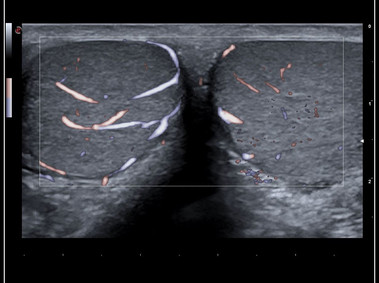 Clinical Image - MyLab<sup>™</sup>9 Platform - XFlow in testis vascularization