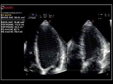 Clinical Image - MyLab<sup>™</sup>X8 Platform - Cardiac - Zero-click EF measurement with Uterus - XLight 3D/4D exploration AutoEF