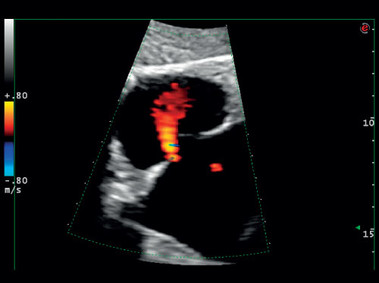 Imagen clínica - MyLab<sup>™</sup>Gamma - Insuficiencia válvula cardíaca (imagen CFM)