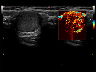 Clinical Image - MyLab<sup>™</sup>9 Platform - Advanced hemodynamic analysis in thyroid nodule with microV