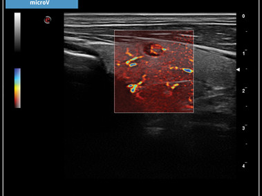 Clinical Image - MyLab<sup>™</sup>X7: microV