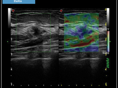 Clinical Image - MyLab<sup>™</sup>X7: ElaXto