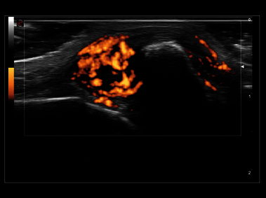 MyLab<sup>™</sup>Sigma Elite - Clinical Image - Power Doppler on acute polyarthritis inflammation area with 18 MHz probe (not available in all countries)