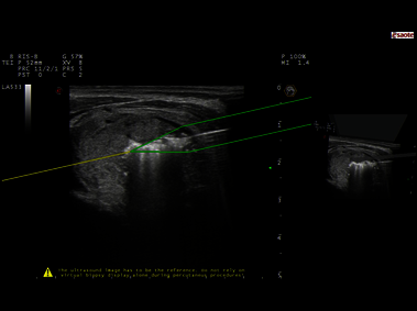 Clinical Image - MyLab<sup>™</sup>Eight eXP - Virtually-guided RF Ablation