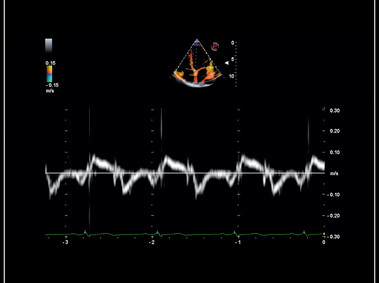 MyLab<sup>™</sup>Sigma - Clinical Image: Mitral valve posterior leaflet analysis with Tissue Velocity Mapping