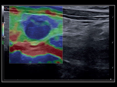 Clinical Image - MyLab<sup>™</sup>X8 Platform - Thyroid - Lesion with ElaXto