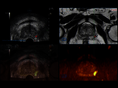 Clinical Image - MyLab<sup>™</sup>Eight eXP - Multiparametric targeting with PET in Gynecology