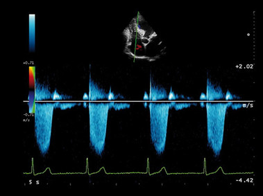 Клиническое изображение – MyLab<sup>™</sup>Alpha – сердце (CW Doppler)