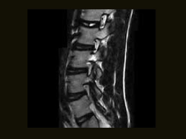 S-scan - L-spine FSE T2 Sagittal