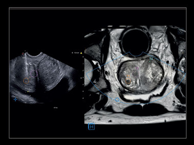 Clinical Image - MyLab<sup>™</sup>X8 Platform - Urology - Prostate biopsy with Virtual Navigator fusion imaging 3D