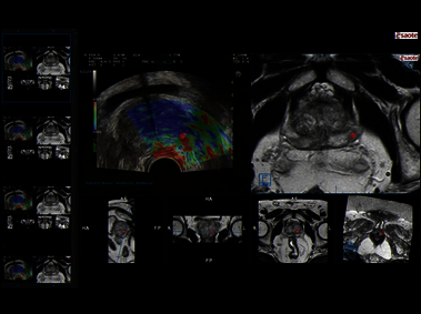 Clinical Image - MyLab<sup>™</sup>Eight eXP - MRI and Elastography real-time Fusion