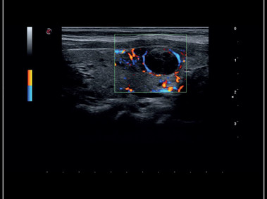MyLab<sup>™</sup>Sigma - Clinical Image: Thyroid lesion, imaging 2D with Color Doppler