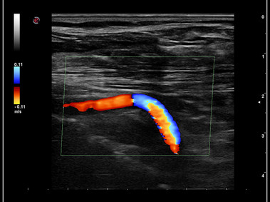 Clinical Image - MyLab<sup>™</sup>9 Platform - Ultra-sensitivity Colour Doppler in detection vertebral artery