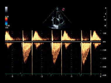 Imagen clínica - MyLab<sup>™</sup>Gamma - Imagen Doppler espectral CW corazón