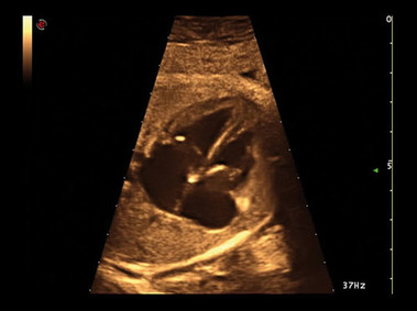 Клиническое изображение – MyLab<sup>™</sup>Alpha – сердце (технология HD Zoom)