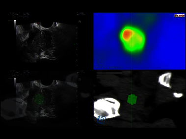 Clinical Image - MyLab<sup>™</sup>Eight eXP - Multiparametric Prostate Fusion