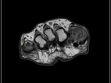 O-scan - Foot - SE T1 Axial