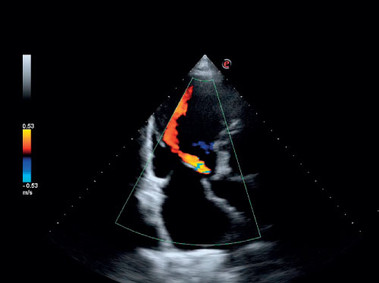 Clinical Image - MyLab<sup>™</sup>Six - Heart Valve Insufficiency (CFM Imaging)