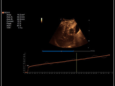 Clinical Image - MyLab<sup>™</sup>9 Platform - QPack CnTI<sup>™</sup> perfusion analysis post RF ablation