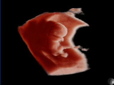Clinical Image - MyLab<sup>™</sup>Twice - 3D Imaging - Obstetrics (XLight)