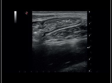 MyLab<sup>™</sup>Sigma - Clinical Image: High Frequency Imaging B-mode of Intestine