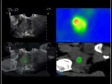 Clinical Image - MyLab<sup>™</sup>9 Platform - Gynecology fusion imaging with PET for best lesion location