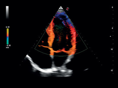 Klinisches Bild – MyLab<sup>™</sup>Gamma – Herzgewebe-Doppler (TVM-Bildgebung)