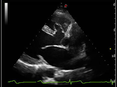 Clinical Image - MyLab<sup>™</sup>9 Platform - TEI<sup>™</sup> harmonic imaging for clear visualization of perimembranous ventricular septal