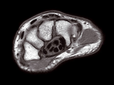 O-scan – Запястье, спин-эхо, осевая проекция Т1