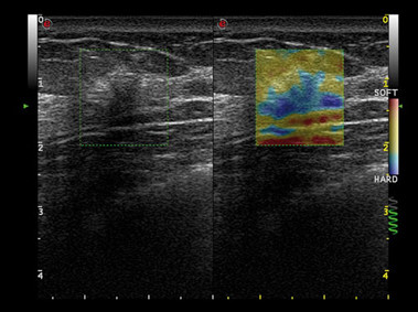 Клиническое изображение – MyLab<sup>™</sup>Alpha – исследования груди (технология Elaxto)