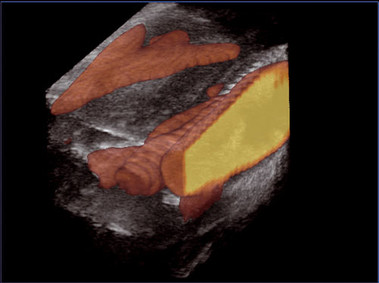 Клиническое изображение – MyLab<sup>™</sup>Twice – сонная артерия (технология 4D)