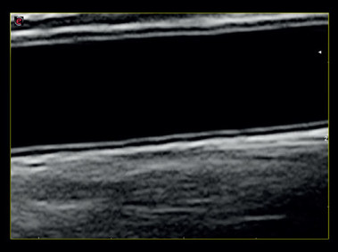 Imagen clínica - MyLab<sup>™</sup>Gamma - Arteria carótida - Mejora íntima-media (TEI&amp;trade; - MVIEW - imagen XVIEW)