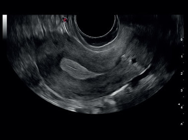 Clinical Image - MyLab<sup>™</sup>Six - Uterus (TEI&trade; - MView - XView Imaging)