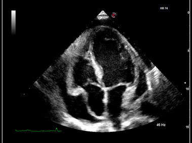 Clinical Image - MyLab<sup>™</sup>9 Platform - XView real-time algorithm reducing speckle noise artefact in pathologies analysis quantification