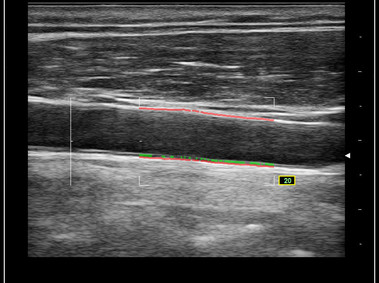 Clinical Image - MyLab<sup>™</sup>Omega - RF-QIMT