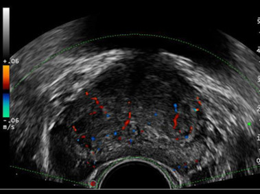 Clinical Image - MyLab<sup>™</sup>Alpha - Prostate Transrectal Imaging