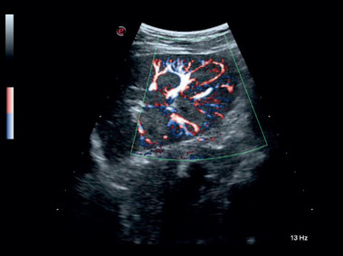 Imagen clínica - MyLab<sup>™</sup>Gamma - Vascularización renal (imagen XFlow)