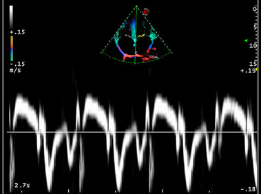 Clinical Image - MyLab<sup>™</sup>9 Platform - Tissue Velocity imaging to quantify septal velocity and dyssynchrony