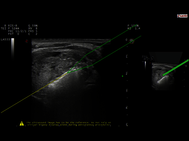 Clinical Image - MyLab<sup>™</sup>Eight eXP - Neck Ablation with Virtual Needle