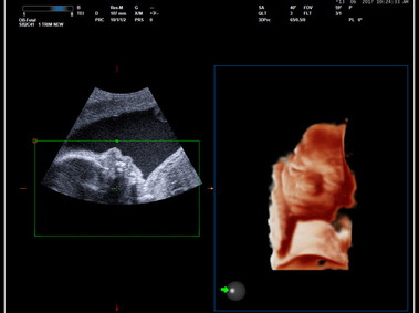 Clinical Image - MyLab<sup>™</sup>9 Platform - Real-time baby face with 4D imaging