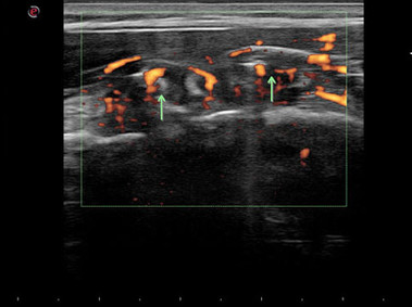 Clinical Image - MyLab<sup>™</sup>Alpha - Elbow