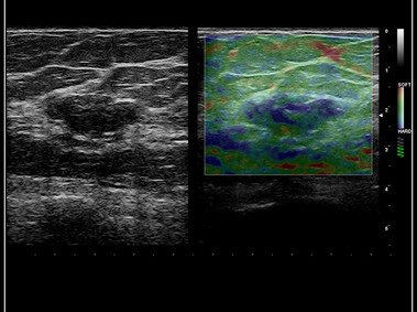 Clinical Image - MyLab<sup>™</sup>9 Platform - Dual ElaXto characterization on breast lesion