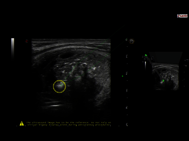 Clinical Image - MyLab<sup>™</sup>Eight eXP - Neck laser ablation with IP & Virtual Biopsy