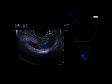 Clinical Image - MyLab<sup>™</sup>Eight eXP - Virtual Biopsy on Postate target