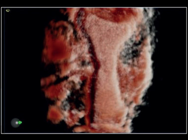 Clinical Image - MyLab<sup>™</sup>X8 Platform - Uterus - XLight 3D/4D exploration