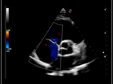 Clinical Image - MyLab<sup>™</sup>Omega - Short Axis Big Vessel Right Ventricle CFM