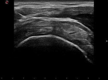 Clinical Image - MyLab<sup>™</sup>Gamma - Supraspinatus