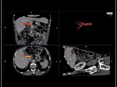 Clinical Image - MyLab<sup>™</sup>9 Platform - Virtual Navigator automatic vascular detection and segmentation with Auto-Fusion